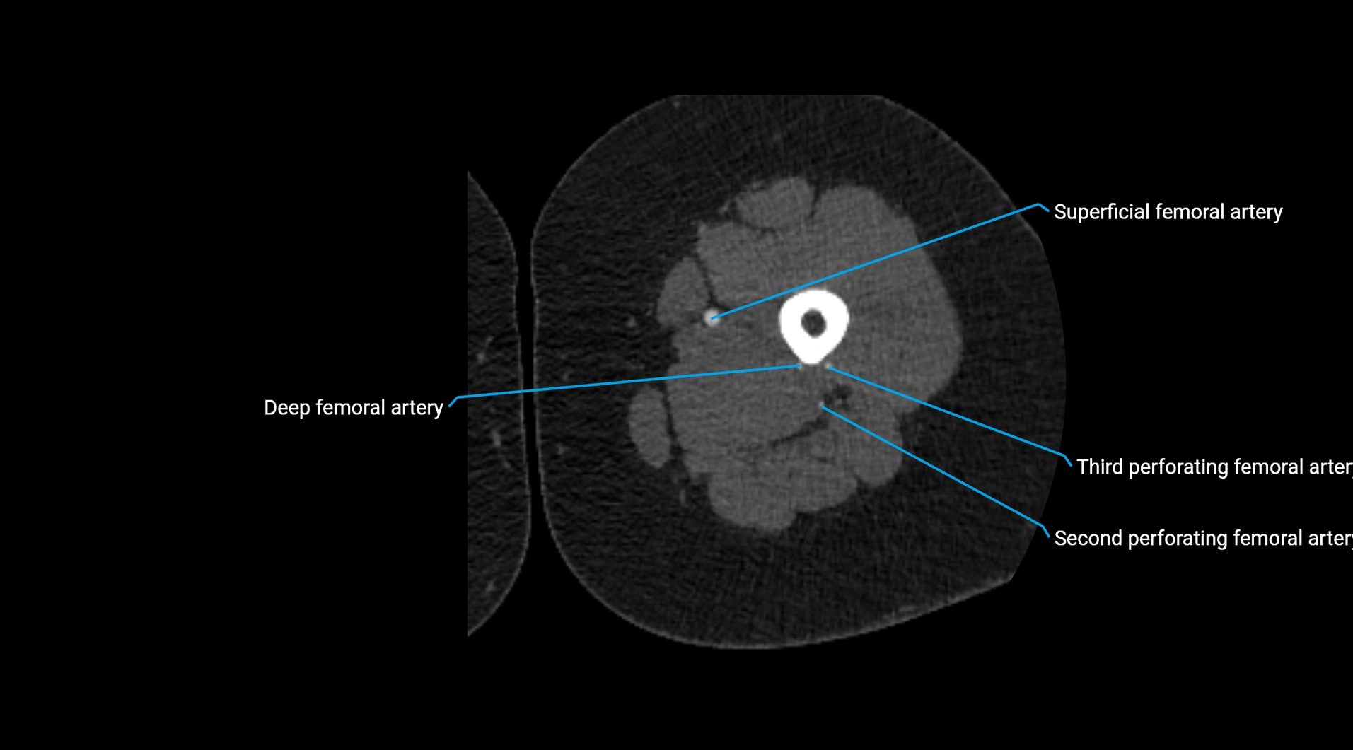 CTA lower limb cross sectional anatomy labelled image _120.webp